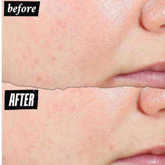 KIEHL'S Expertly Clear Acne-Treating & Preventing Lotion NWT - Picture 10 of 10